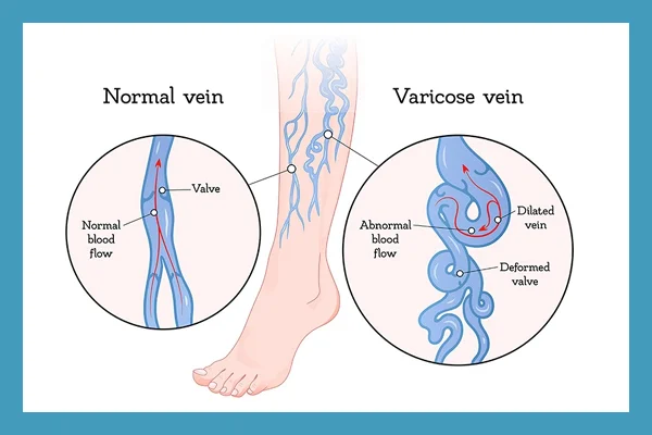 Varicose Veins Treatment